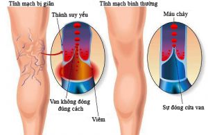 Tĩnh mạch bị giãn và tĩnh mạch bình thường.